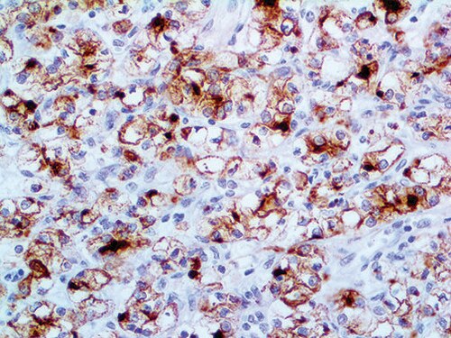 IHC of Renal Cell Carcinoma on an FFPE Kidney Tissue